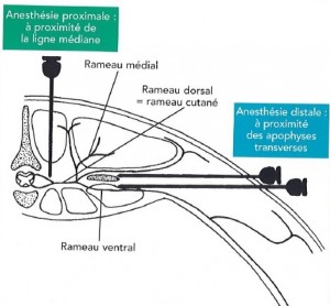 Figure 16 Schéma de l'emplacement des aiguilles lors d'injections paravertébrales proximale et distales
