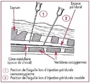 positionnement de l'aiguille lors d'une anesthésie épidurale- epidural gtv n8 ete 2000